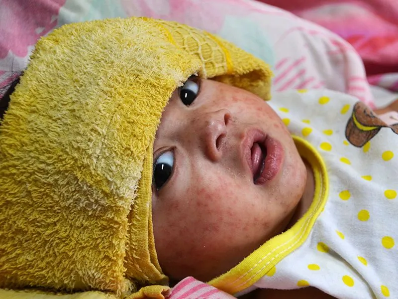 bebê com dermatite no rosto foto