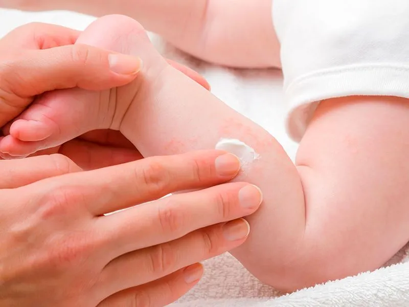 pomada para dermatite em bebê